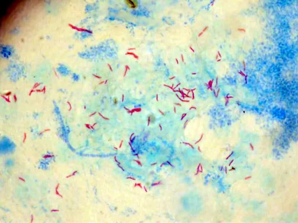 Палочки в мокроте. Микобактерия туберкулеза по Цилю Нильсену. Mycobacterium tuberculosis окраска по Цилю-Нильсену. Микобактерии туберкулеза окраска по Цилю-Нильсену. Микобактерии туберкулеза микроскопия по Цилю Нильсену.